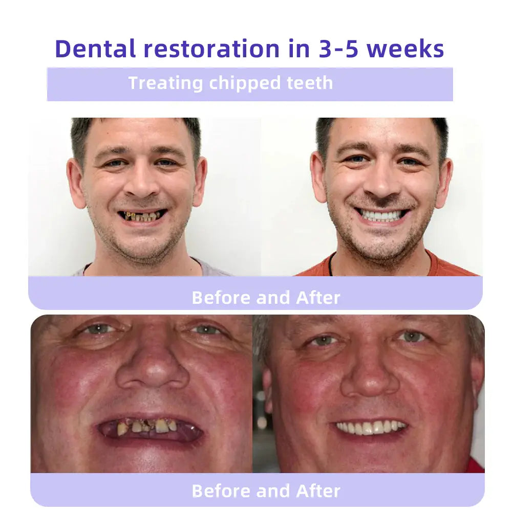 Oyikey®✅ Минерален прах за възстановяване на зъби